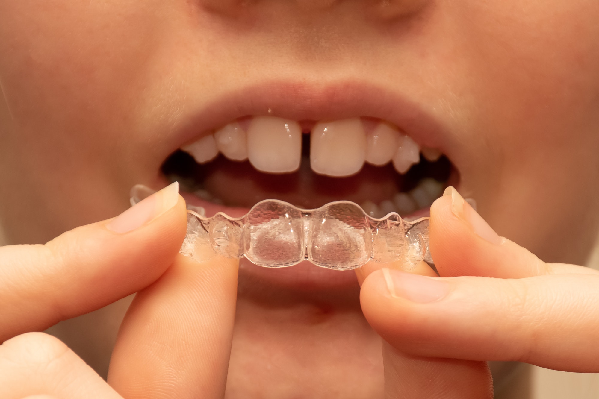 Invisible Braces (Aligners) Northfield Dental Clinic